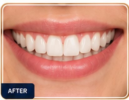 braces-after
