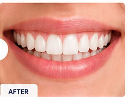 whitening-after
