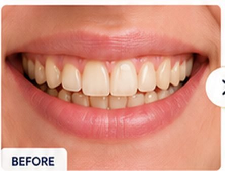 whitening-before
